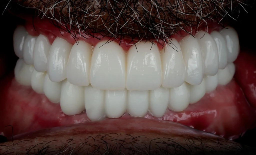 Final Smile Result with Monolithic Zirconia & Porcelain