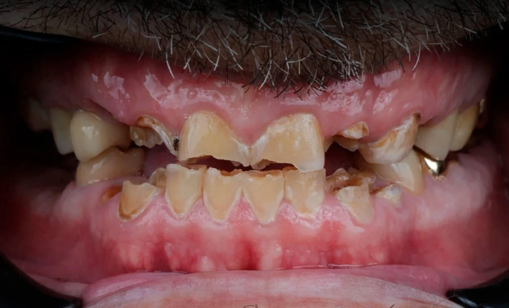 Patient Initial State Before Treatment